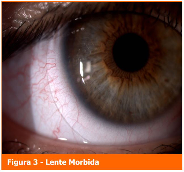 Lente Morbida - Professione Oculista