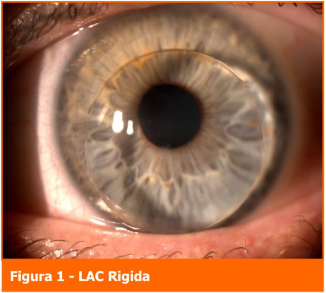 Lente rigida- Professione Oculista