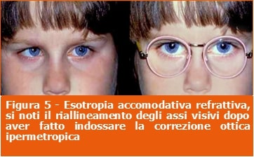 Esotropia accomodativa refrattiva-strabismo-professione oculista-ECM-Medical Evidence