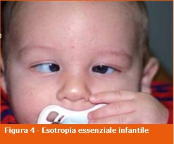 Esotropia essenziale infantile-strabismo-professione oculista-ECM-Medical Evidence